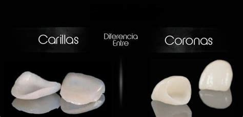 Diferencia Entre Carillas Y Fundas O Coronas Abaden Dentistas