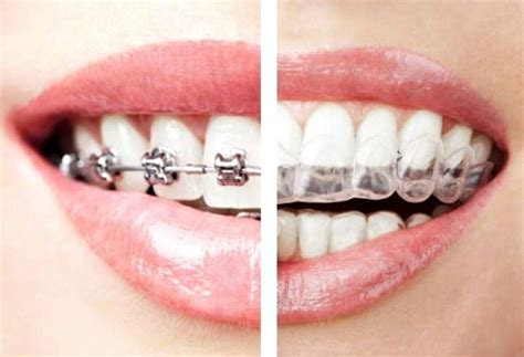 Comparing Traditional Braces With Invisalign Tooth Fairy Dental