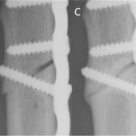 Serial Radiographs Of A Freehand Osteotomy With Unparallel Osteotomy