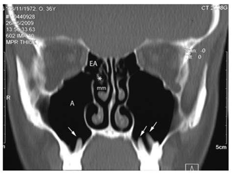 Ct Scan Coronal Plane Of The Maxillary And Anterior Ethmoid Area