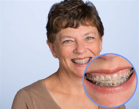 Your Comprehensive Guide To Braces Achieve A Perfect Smile American Association Of Orthodontists