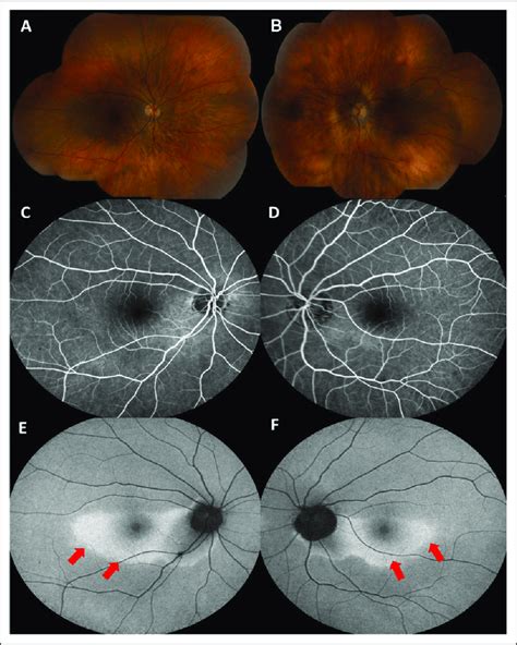 Color Fundus Photograph Fluorescein Angiography And Fundus