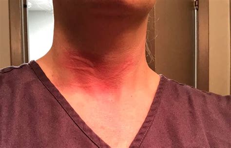 Red Swelling And Hives On The Neck Writing Pictures Urticaria Hives
