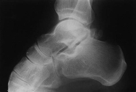 The Sequelae Of Posterior Talar Fractures Injury