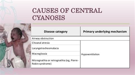 Overview Of Cyanosis In The Newborn