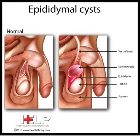 Sand up the nose can be a. Epididymal Cyst | WAUROLOGY