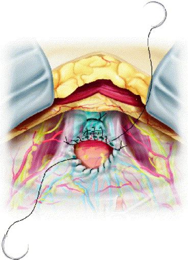 Improving The Preservation Of The Urethral Sphincter And Neurovascular