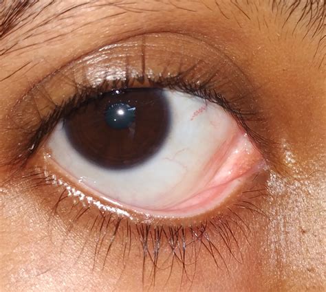Itchy Lacrimal Caruncle Web Eye Clinic