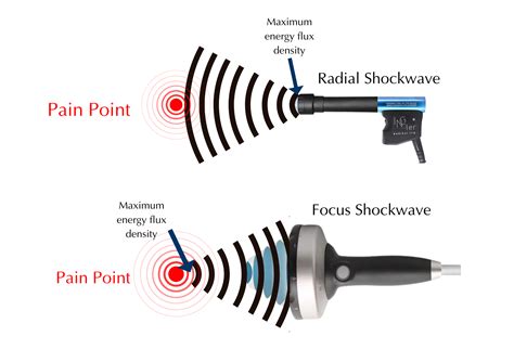 Difference Between Focus Shockwave Therapy And Radial Shockwave Therapy