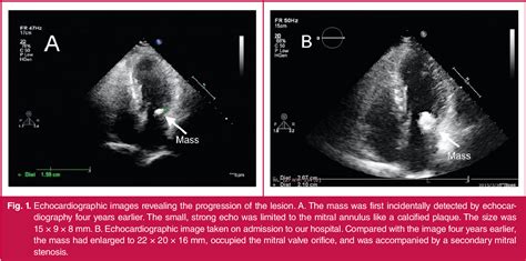 Pdf Caseous Calcification Of The Mitral Annulus Mimicking Benign