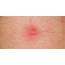 What’s On My Skin 8 Common Bumps Lumps And Growths  Disorders