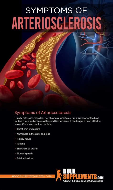 Arteriosclerosis Symptoms Causes Treatment By James Denlinger