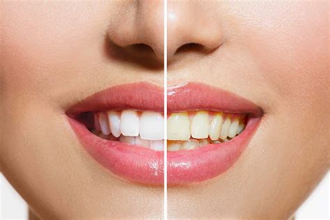 Yellow Teeth Are Actually Stronger Than Bright White Teeth Readers
