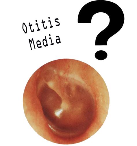 Penatalaksanaan Otitis Media Apotekers