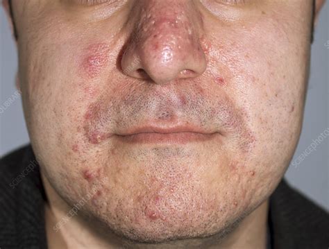 Acne Pimples And Scars Stock Image C0142524 Science Photo Library