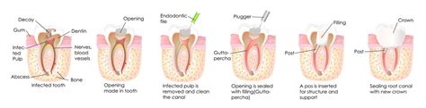 Check spelling or type a new query. Root Canal Treatment | Apex Dentist