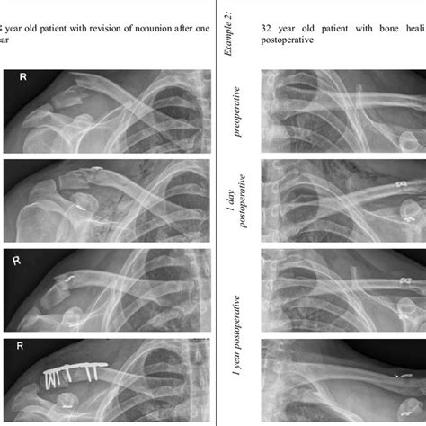 Case Presentation Of Two Patients With Unstable Lateral Clavicle