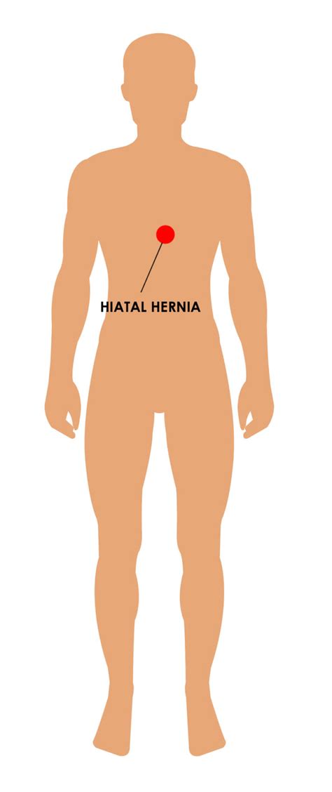 Epigastric Hernia Types