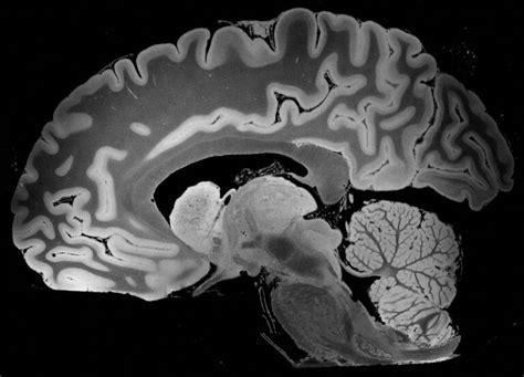Ultra High Resolution Mri Of Human Brain Sets New Heights