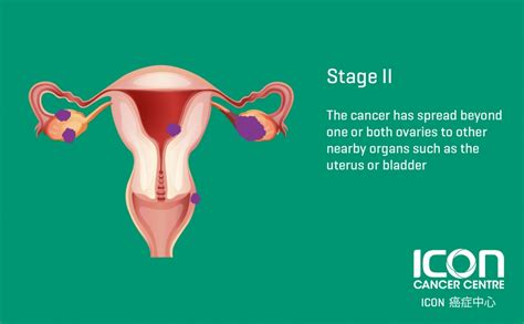 Ovarian Cancer — Icon Cancer Centre Hong Kong