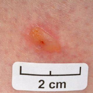 This test may be given to patients suspected of bd, but it is not an indicator for the disease. 2 Pathergy test in Behçet's disease-pustule induced by a ...