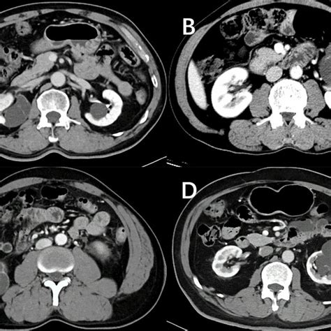 Nephrographic Phase Images For Four Cystic Renal Lesions In The Testing