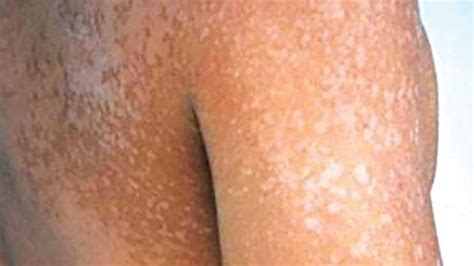What Causes Small White Spots On The Body Whats The Best Treatment