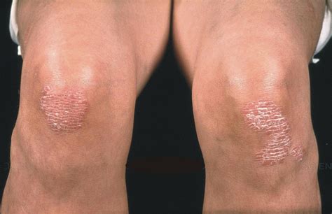 Dry Skin Could Be Psoriasis