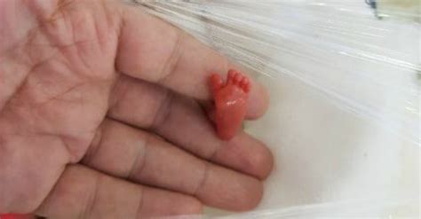 Baby Born 12 Weeks Prematurely And Weighing Just 0.8 lb Is ...