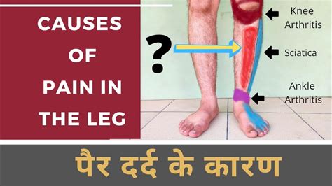 Causes Of Leg Pain Shin Splint Calf Strain Sciatica Varicose