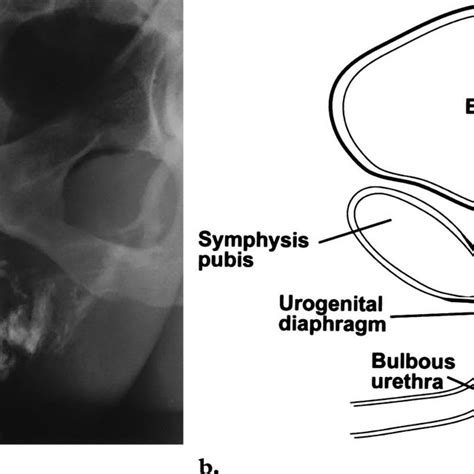 Gonococcal Urethral Stricture Retrograde Urethrogram Reveals A Segment