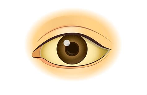 Yellowing In The Human Eye Stock Illustration Download Image Now Istock