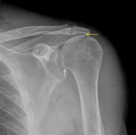 Shoulder Ap View Acromio Humeral Distance Reduction Yellow Arrow In