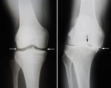 Joint Replacements And Osteoarthritis Max Superspecialty Ortho Clinic