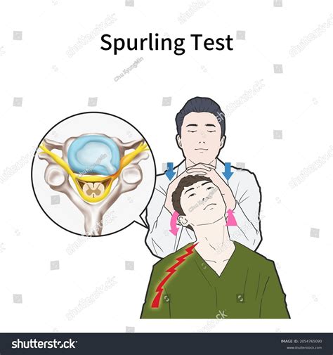 3d Medical Illustration Explain Spurling Test Stock Illustration