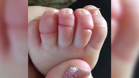 Mom S Photo Of Baby S Swollen Foot Sparks Awareness About Rare Condition Good Morning America
