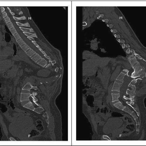 Sagittal Plane Of Preoperative Ct Scan A Severe Sagittal Deformity Is