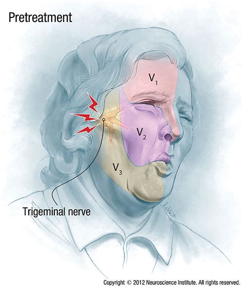 Trigeminal Neuralgia As Related To Nerves Pictures