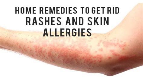 Home Remedies to get rid of Rashes and Skin Allergies 