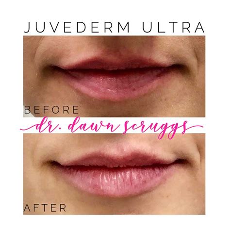 Juvederm Fillers Orlando Cosmetics Lake Mary Cf Eye Specialists