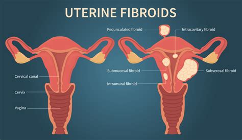 Uterine Fibroid Embolization Specialist Los Angeles Ca And Encino Ca