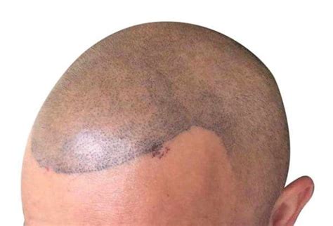 13 Scalp Micropigmentation Pros and Cons (Men & Women ...