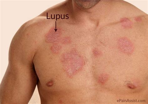 Lúpus Eritematoso Sistêmico Tratamento Sintomas Causas E Diagnóstico