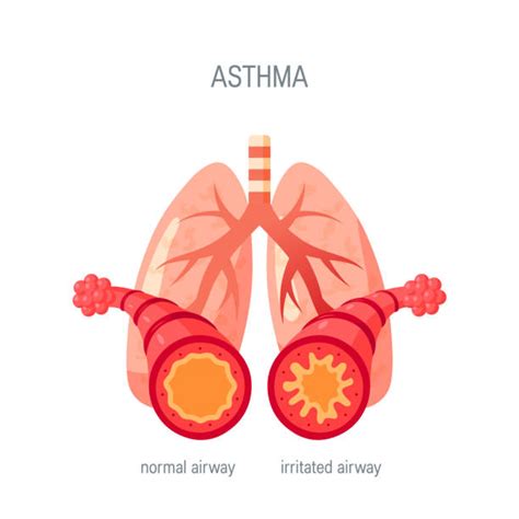 Asthma Cartoon Illustrations, Royalty-Free Vector Graphics & Clip Art