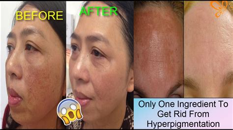 How To Get Rid Of Dark Spots And Hyperpigmentation Fast Youtube