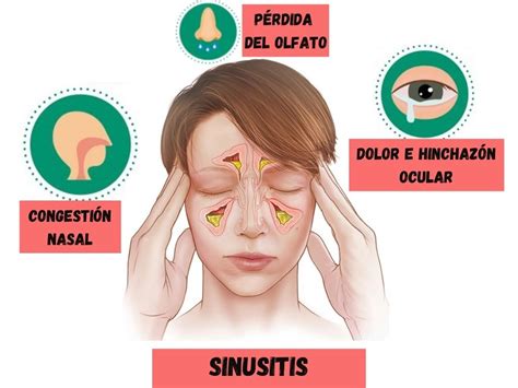 Sinusitis Aguda S Ntomas Y Causas The Best Porn Website