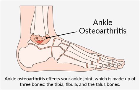 Ankle Osteoarthritis Pt Health
