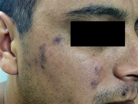 Caso Nº2 Ed351 Dermatoscopía A Propósito De Un Caso De Lupus