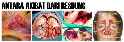 Jerawat di dalam hidung bisa jadi merupakan pertanda terjadinya infeksi di dalam hidung. JAMU SUSUK DARA: RESDUNG DAN RAWATANNYA