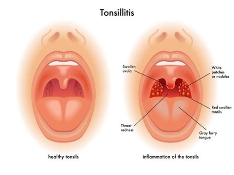 Tonsilitis Patofisiologi Diagnosis Penatalaksanaan Alomedika